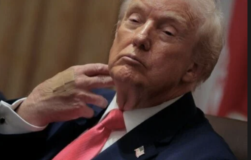 Trump blames bruised hand on aspirin, denies falling asleep