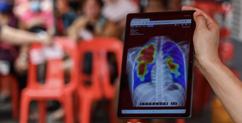 الصحة العالمية: وفاة أكثر من مليون شخص بمرض السل